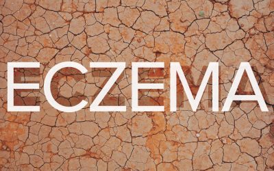 ECZEMA!!!
